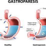 Gastroparese