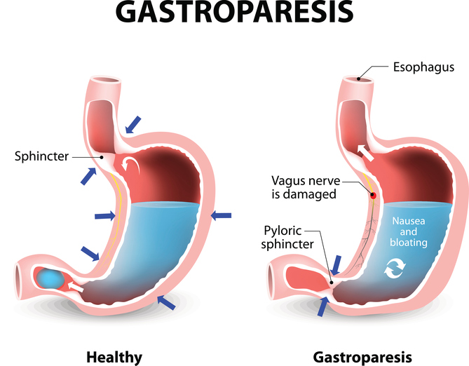 Gastroparese
